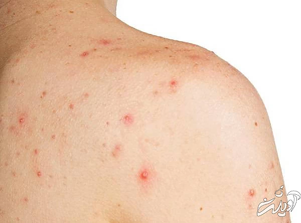 لباس کثیف و جوش